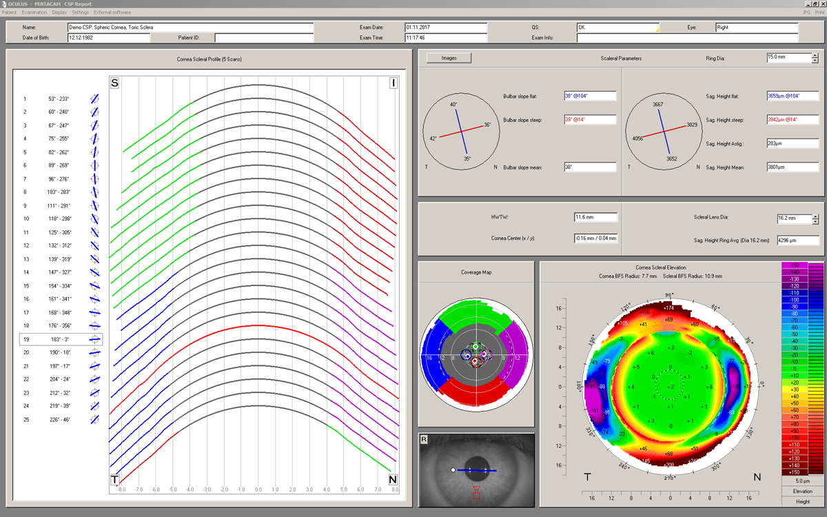 Cornea sclera profile measurement with the Pentacam (Oculus).
